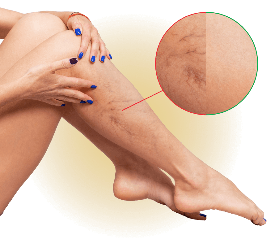 Spider Vein Removal Treatment