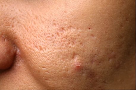 Dark Spots Treatments in Melbourne