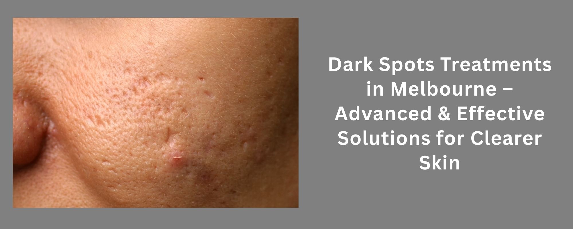 Dark Spots Treatments in Melbourne