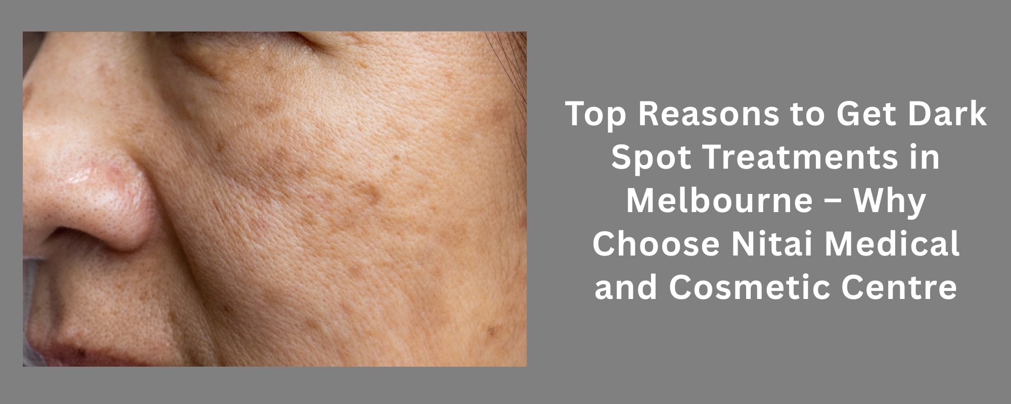 Top Reasons to Get Dark Spot Treatments in Melbourne
