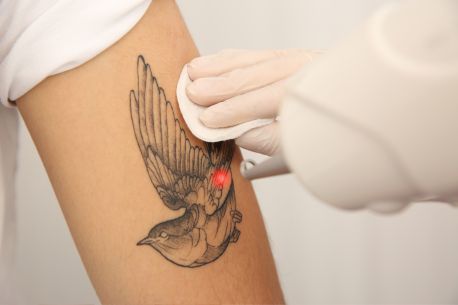 Top 5 Reasons to Choose Laser Tattoo Removal in Melbourne - 1