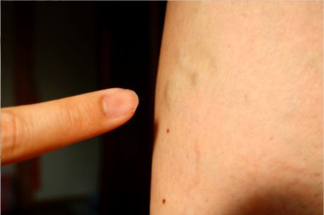 A Simple Guide to Varicose Vein Treatment in Melbourne How It Helps and Who Needs It