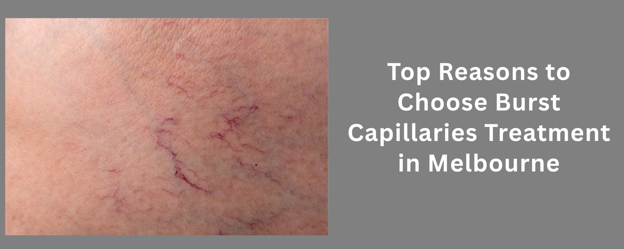 Excessive Underarm Sweating