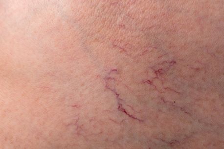 Top Reasons to Choose Burst Capillaries Treatment in Melbourne