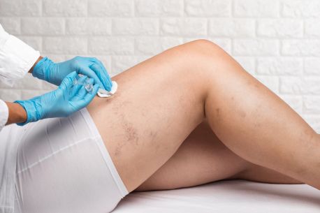 Spider Vein Removal in Melbourne