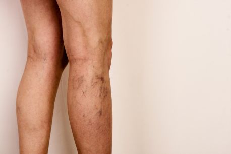 Top Reasons to Undergo Varicose Vein Treatment in Melbourne