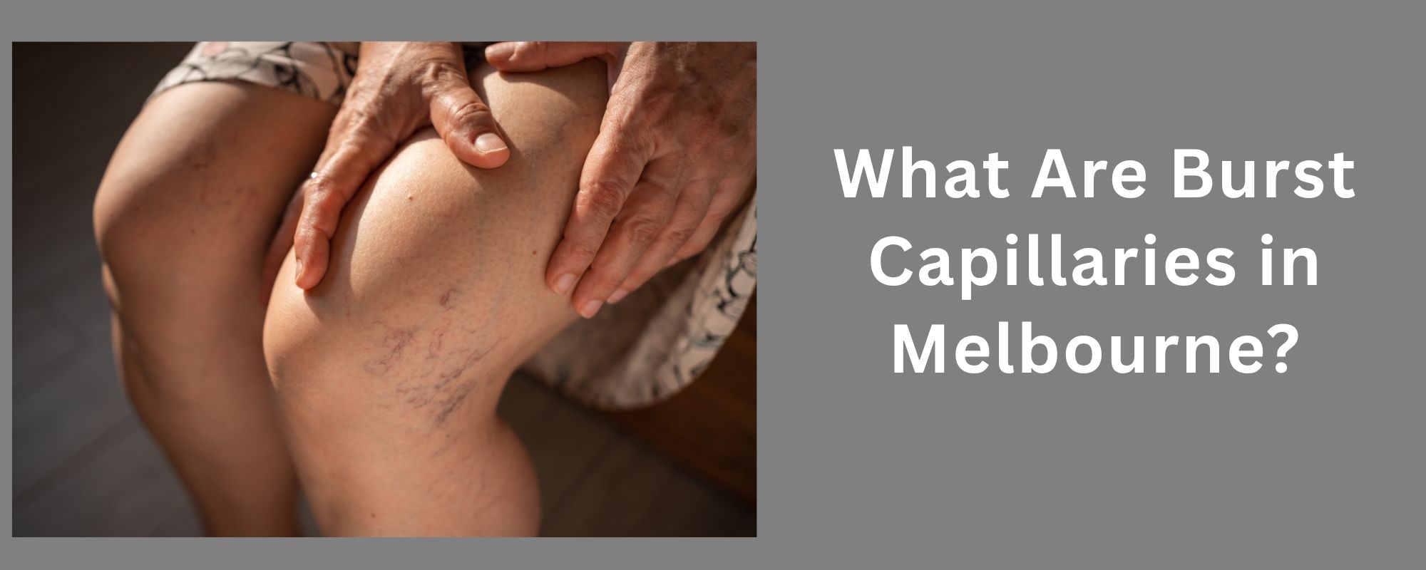 What Are Burst Capillaries in Melbourne? 1 Excessive Underarm Sweating