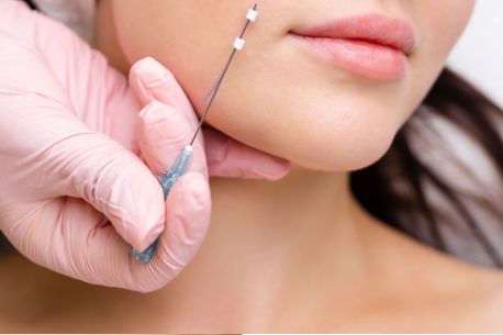 Understanding Thread Lift Treatment: The Secret to Refreshed Skin in Melbourne