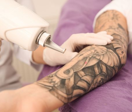 Laser Tattoo Removal Melbourne: Why Professional Treatment Is the Smart Choice for Removing Unwanted Tattoos