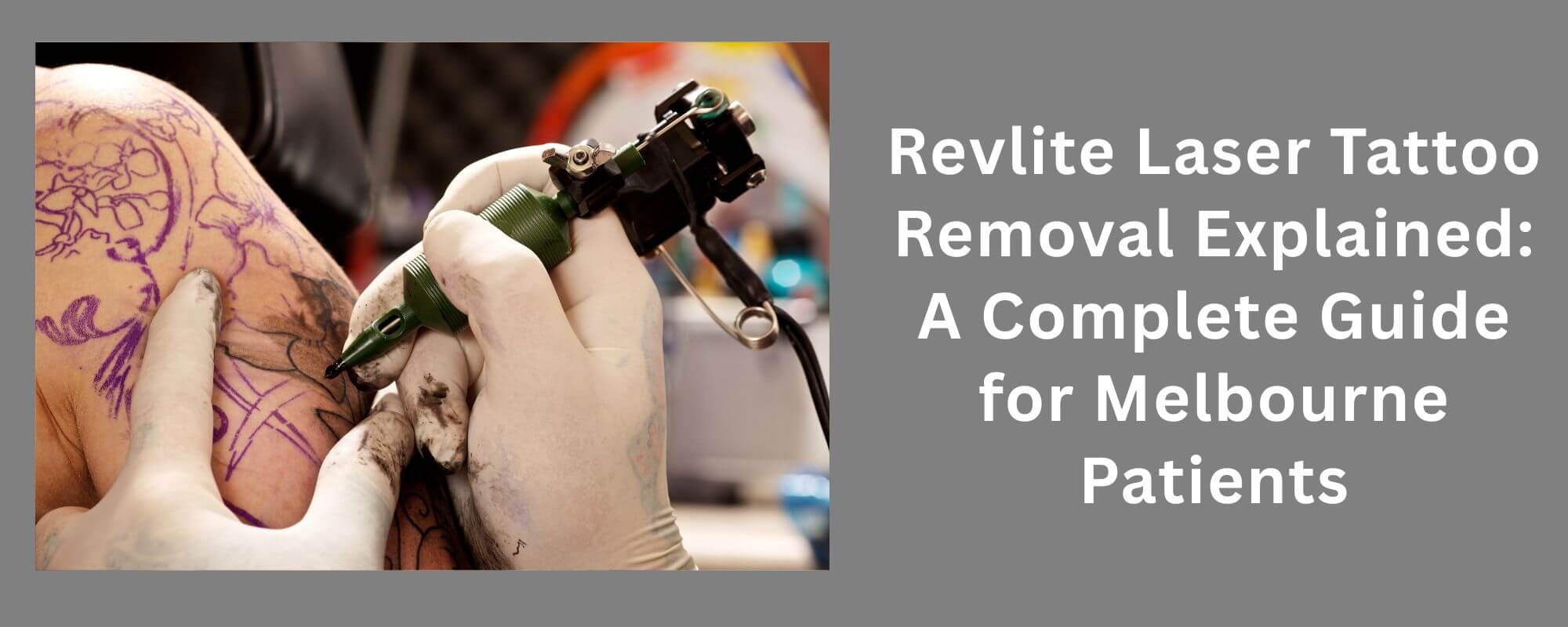 Laser Tattoo Removal in Melbourne