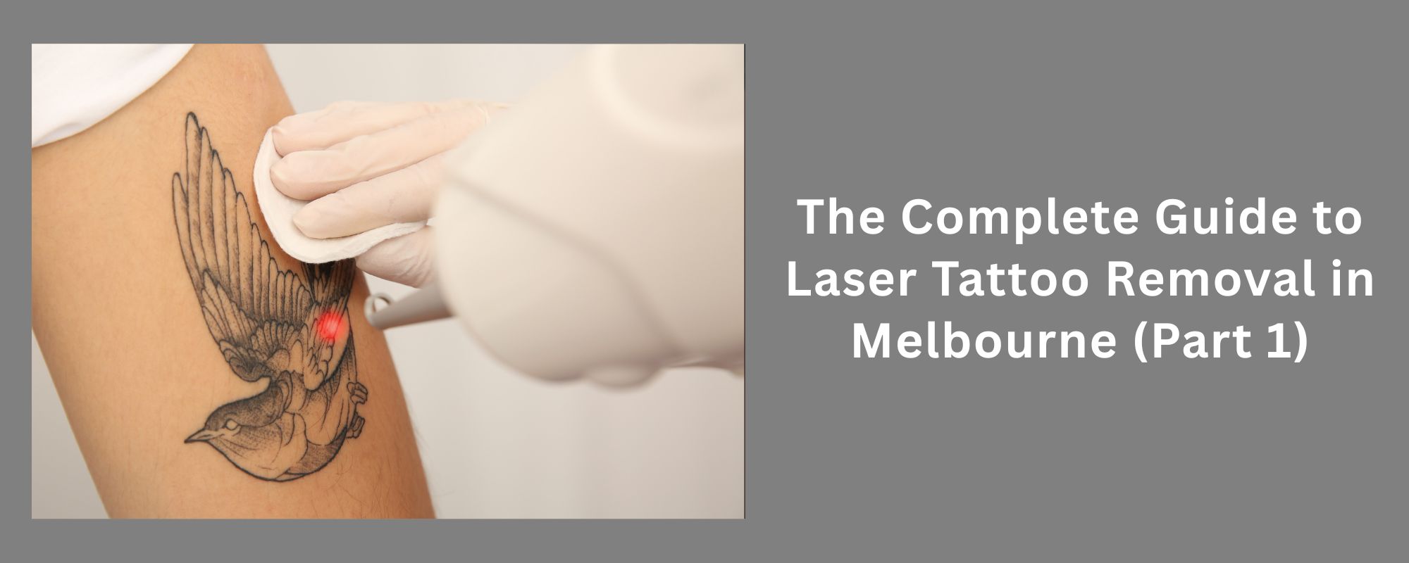 The Complete Guide to Laser Tattoo Removal in Melbourne (Part 1) 1 Laser Tattoo Removal Melbourne