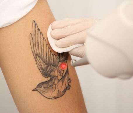 Tattoo Removal in Melbourne