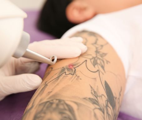 The Complete Guide to Laser Tattoo Removal in Melbourne (Part 2)