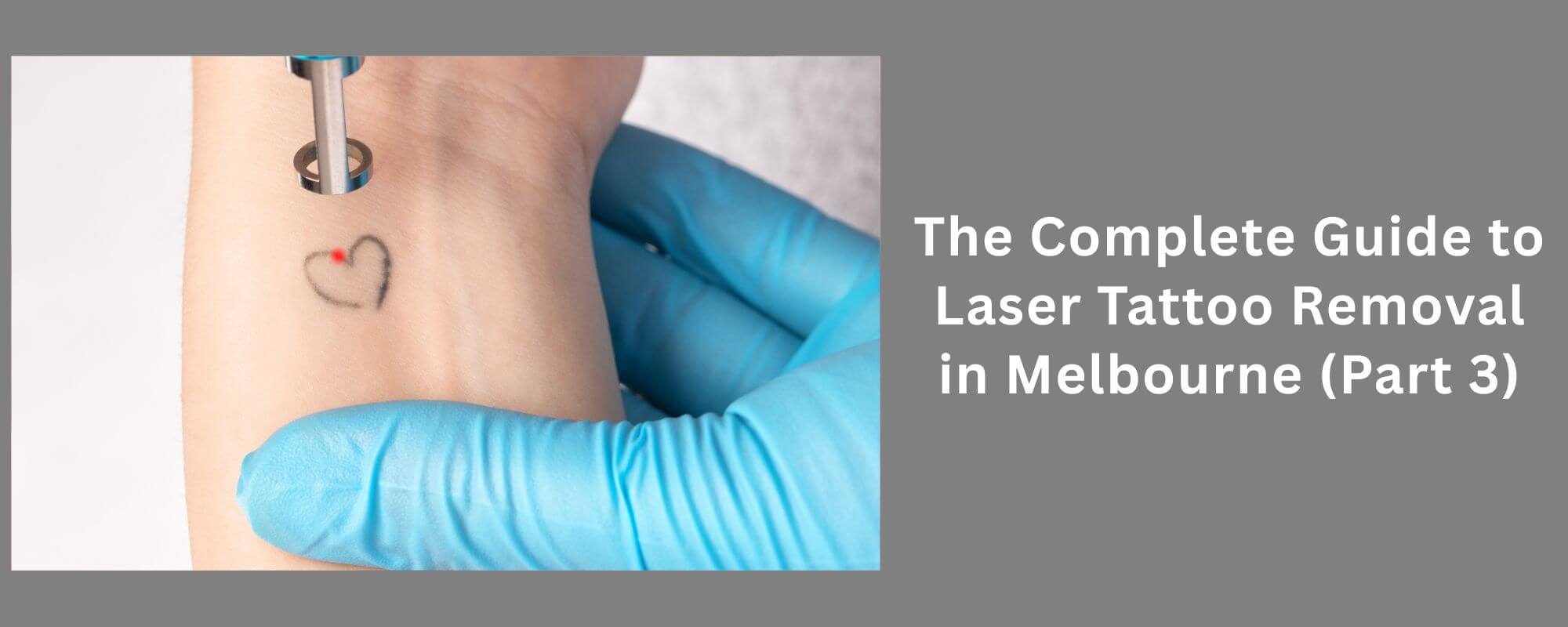 Laser Tattoo Removal in Melbourne