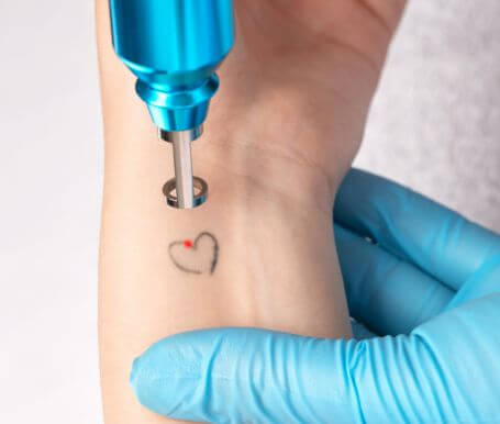 The Complete Guide to Laser Tattoo Removal in Melbourne (Part 3)
