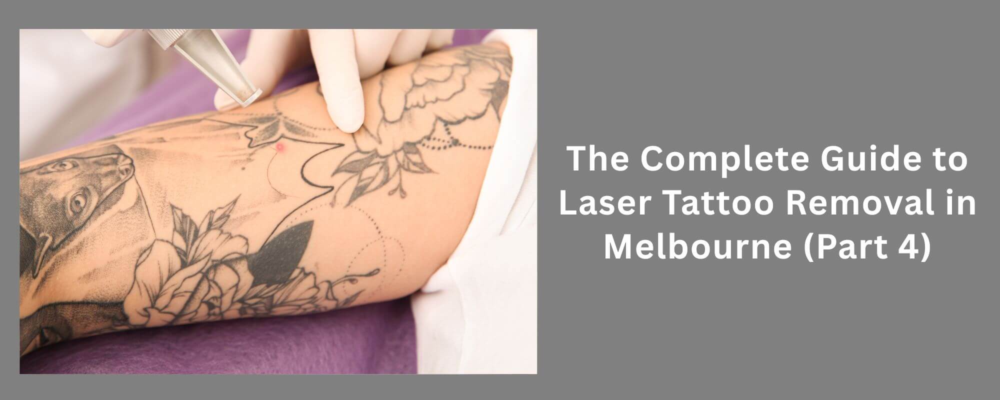 Laser Tattoo Removal in Melbourne