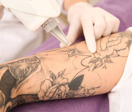 The Complete Guide to Laser Tattoo Removal in Melbourne (Part 4)