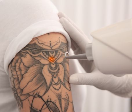 Why Choose Laser Tattoo Removal in Melbourne? 8 Reasons to Book a Professional Consultation